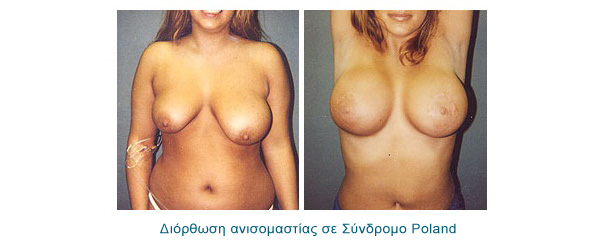 Ανισομαστία - Σύνδρομο Poland