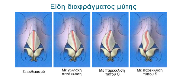Ρινοπλαστική