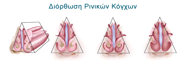 Ρινοπλαστική