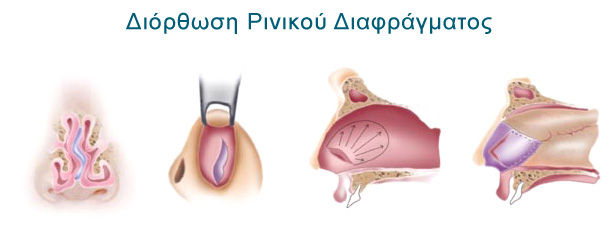 Ρινοπλαστική
